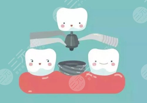 上海九院種牙的價格一般都是多少錢