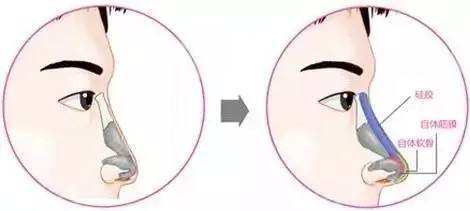 葉麗萍和王艷哪個醫(yī)生鼻子做的不錯?