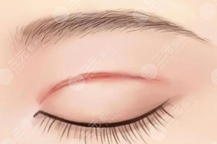 雙眼皮修復(fù)