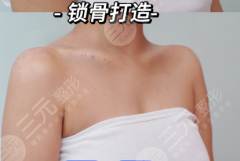 鎖骨整形有什么后遺癥？和“術(shù)式+醫(yī)院”直接掛鉤
