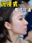 眉弓骨填充多少錢？填充價(jià)格=材料+技術(shù)+安全保障