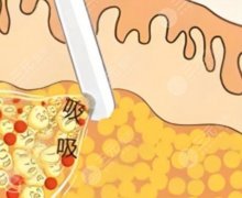 肩部吸脂好還是瘦肩針好？一文教你分清肩部吸脂和瘦肩針的區(qū)別