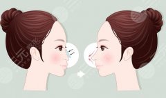 內(nèi)蒙古醫(yī)科大學(xué)附屬醫(yī)院假體隆鼻多少錢(qián)？2026年價(jià)格表更新！