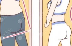 媽媽臀抽脂后多久能恢復(fù)？坐立、上班、運(yùn)動(dòng)分別什么時(shí)候可以恢復(fù)？