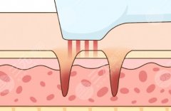 5d膠原光會(huì)加速衰老嗎？別瞎猜了！內(nèi)行人帶你扒清真相