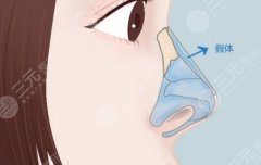 上海國(guó)際醫(yī)學(xué)中心隆鼻價(jià)格，有人花幾萬(wàn)有人十幾萬(wàn)？?jī)r(jià)格差異全拆解