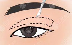 成都眼修復(fù)醫(yī)生排名，從案例難度、審美風(fēng)格到患者反饋全面對(duì)比