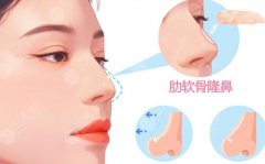 半肋骨鼻和全肋骨鼻哪個(gè)更好？從支撐力、塑形空間到疤痕位置一文講透