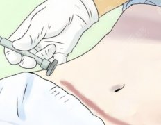 腹壁皮膚脂肪切除術(shù)，疤痕位置、風(fēng)險(xiǎn)點(diǎn)和術(shù)后護(hù)理要點(diǎn)全解析