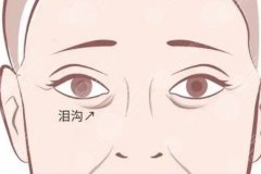 北京玻尿酸填充淚溝最佳年齡，從皮膚狀態(tài)、凹陷程度分析適合介入的時(shí)間點(diǎn)