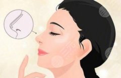 膨體隆鼻幾天才消腫？正常消腫時(shí)間和異常情況判斷指南