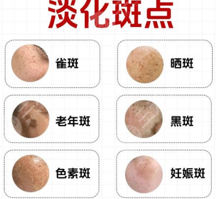 祛斑