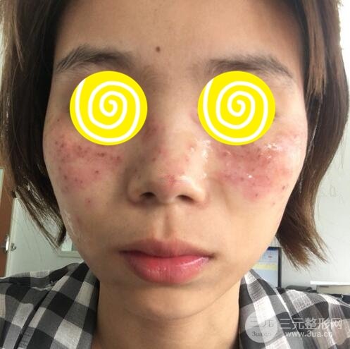激光祛斑三天后的照片和幾天結(jié)痂脫落過程案例