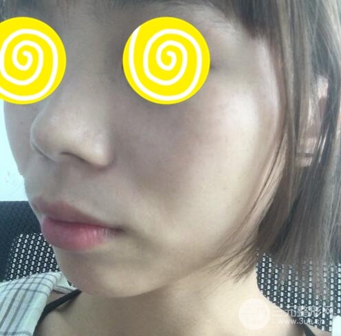 激光祛斑三天后的照片和幾天結(jié)痂脫落過程案例